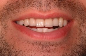 After - Stoke Bishop Dental Centre