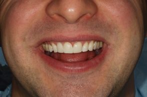 After - Stoke Bishop Dental Centre