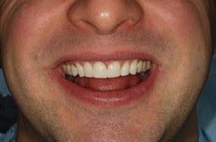 After - Stoke Bishop Dental Centre