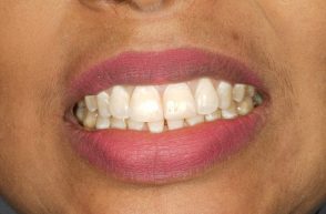 After - Stoke Bishop Dental Centre