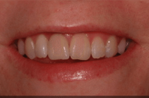 After - Stoke Bishop Dental Centre